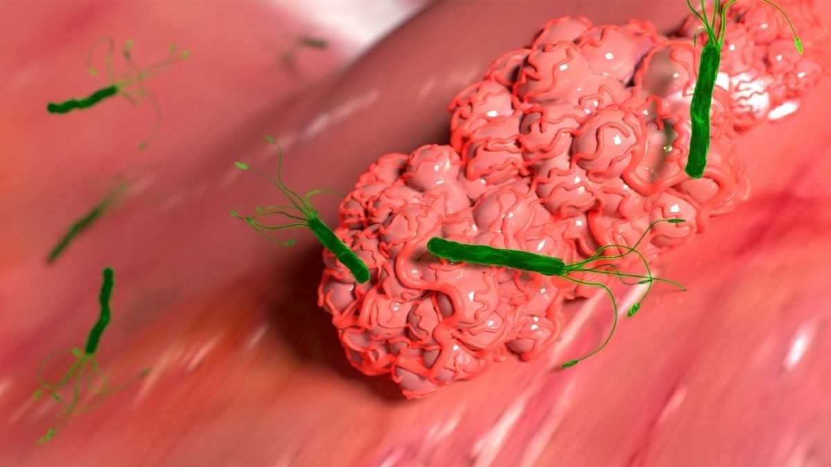 Syringoma, Tumor Jinak di Area Pipi dan Kelopak Mata - KlikDokter