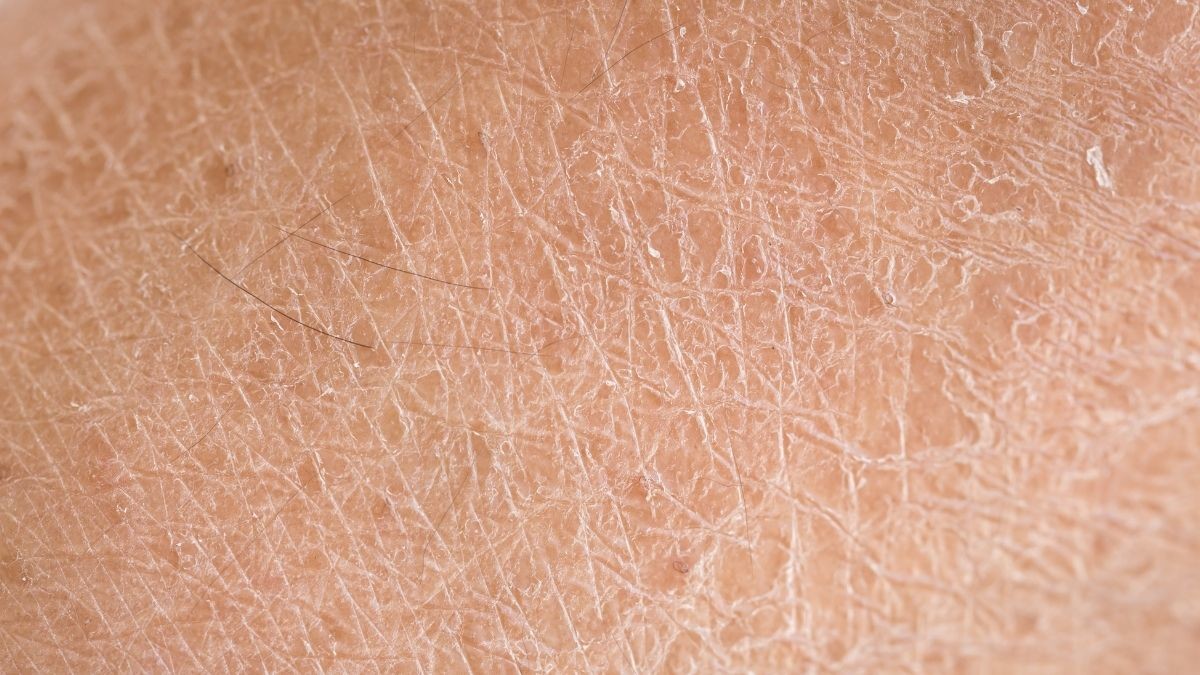 Kulit Kering (Tangkapan Layar)