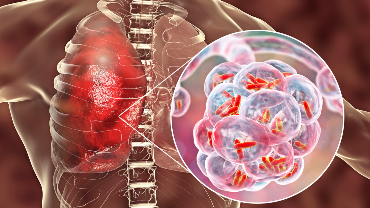Bahaya Asap Karhutla bagi Paru-Paru dan Risiko Pneumonia