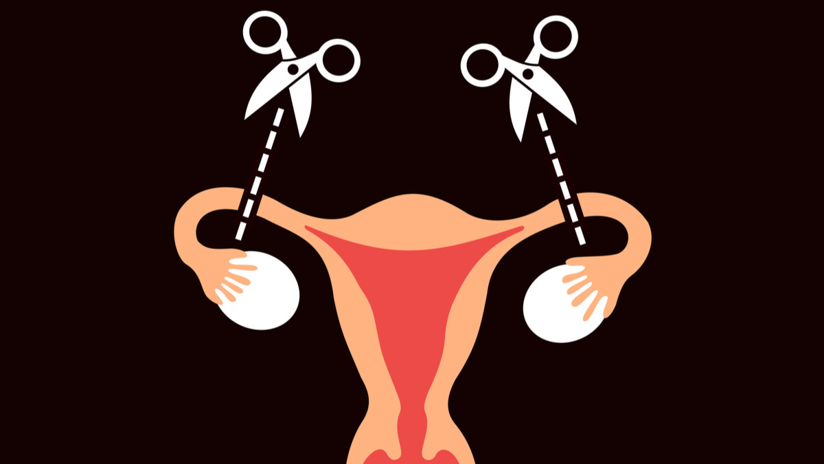 Mengenal Kontrasepsi Tubektomi yang Ampuh Cegah Kehamilan - KlikDokter