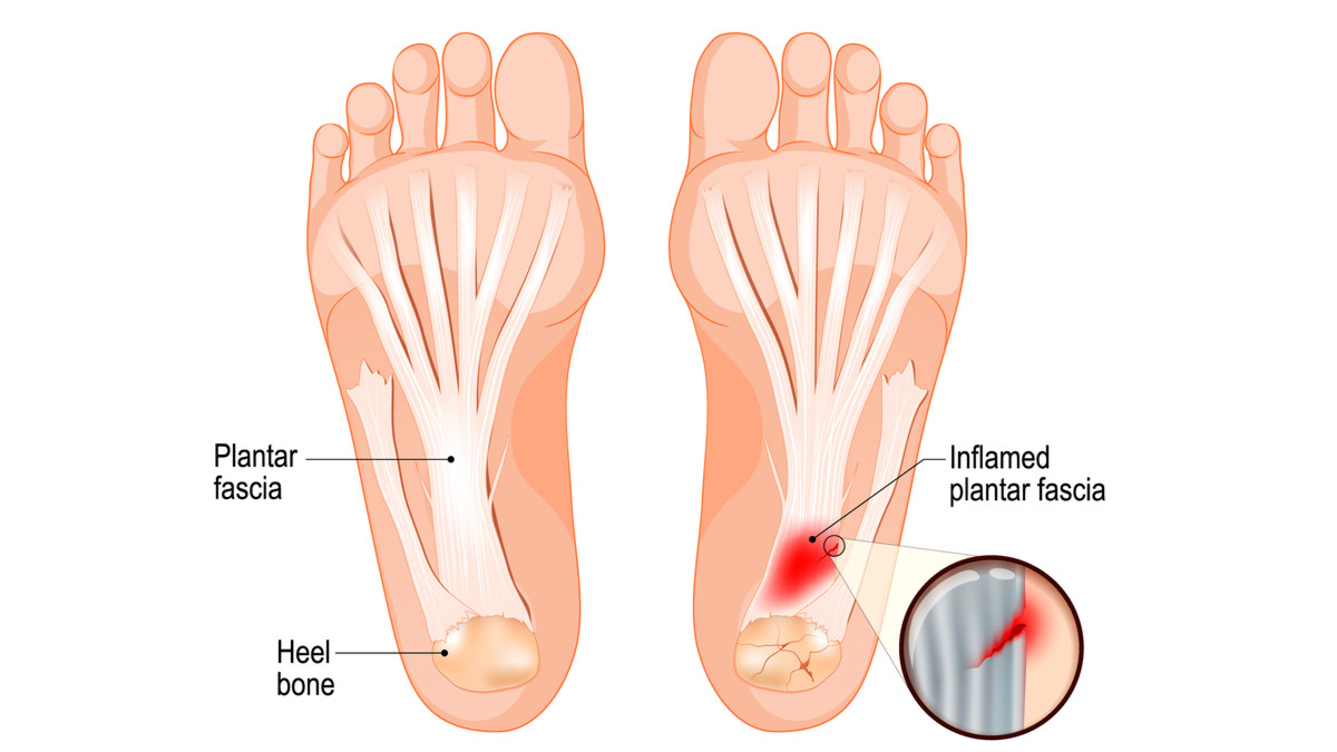 Plantar deals fasciitis terapi