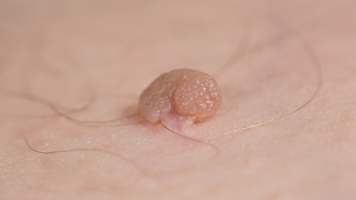 Penyebab Skin Tag dan Cara Efektif Menghilangkannya - KlikDokter