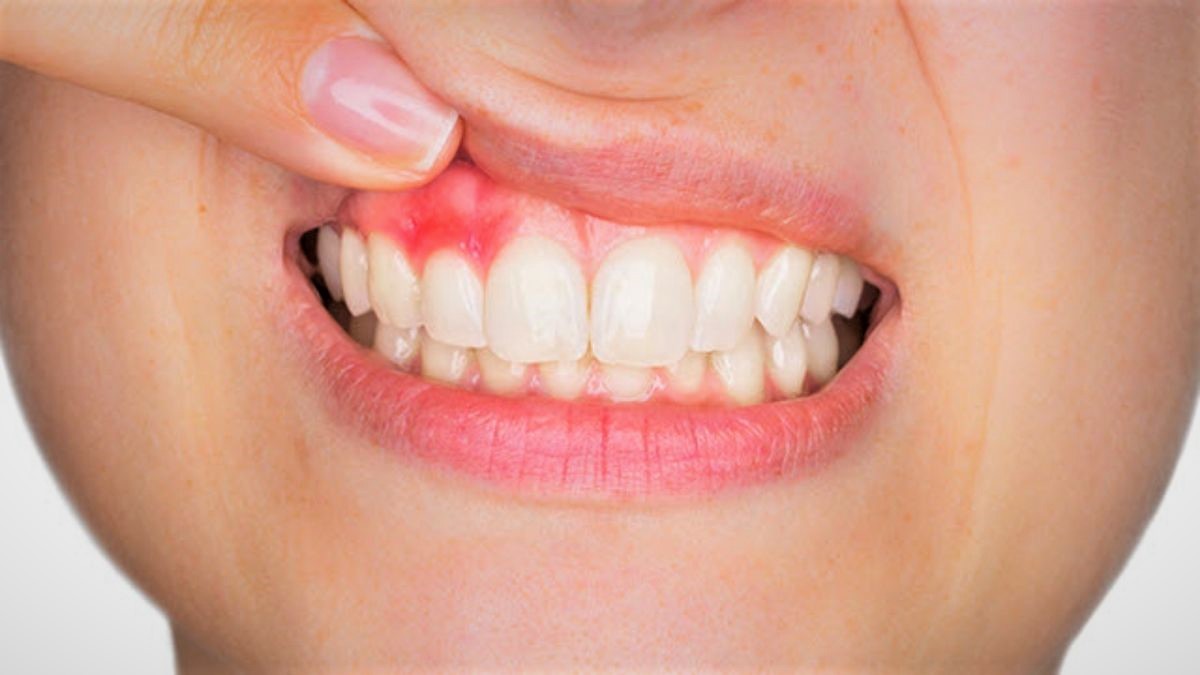 sakit gigi gusi bengkak pada anak apa obatnya 12